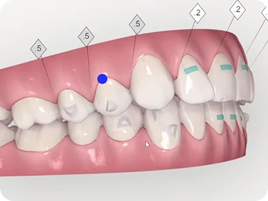 Niềng răng trong suốt Invisalign mang lại kết quả cải thiện rõ rệt chỉ sau 6 tháng niềng.
