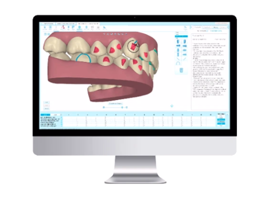 Nha khoa I-Dent ứng dụng công nghệ mô phỏng chuyển động răng 3D qua phần mềm ClinCheck.