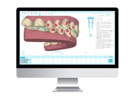 Nha khoa I-Dent ứng dụng công nghệ mô phỏng chuyển động răng 3D qua phần mềm ClinCheck.