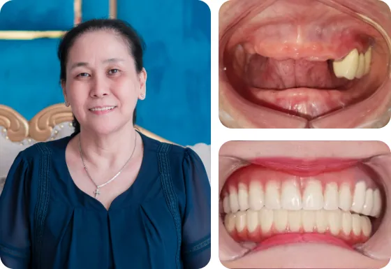 Cô Thanh Phương trồng răng Implant All-on-4 hàm dưới tại nha khoa I-Dent.