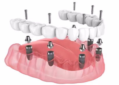 Trồng răng implant toàn hàm All-on-6 tại nha khoa I-Dent.