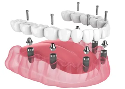 Trồng răng implant toàn hàm All-on-6 tại nha khoa I-Dent.