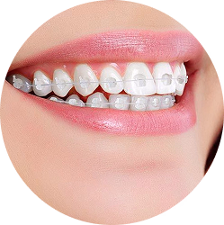 Niềng răng mắc cài sứ.