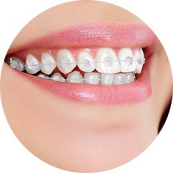 Niềng răng mắc cài sứ.