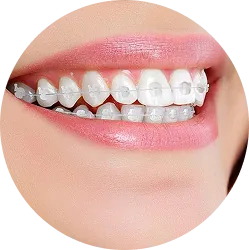 Niềng răng mắc cài sứ.