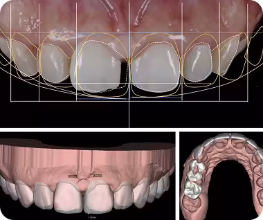Nha khoa I-Dent ứng dụng công nghệ Digital Smile Design để thiết kế nụ cười cá nhân hóa.