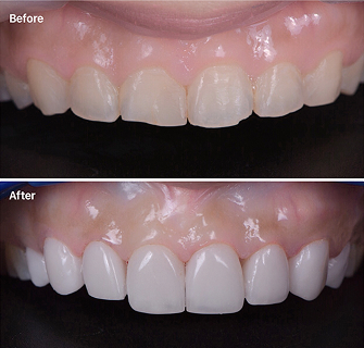 Khách hàng dán sứ veneer điều trị răng mẻ tại I-Dent.