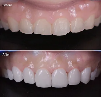 Khách hàng dán sứ veneer điều trị răng mẻ tại I-Dent.