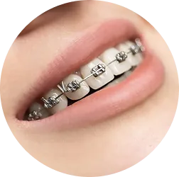 Niềng răng mắc cài kim loại.