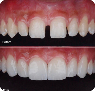 Khách hàng dán sứ veneer điều trị răng thưa tại I-Dent.