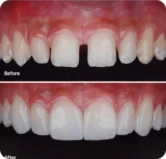 Khách hàng dán sứ veneer điều trị răng thưa tại I-Dent.
