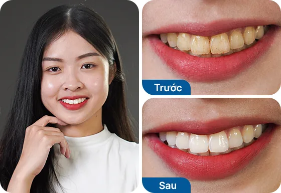 Chị Uyên Phương dán sứ Veneer 14 răng tại nha khoa I-Dent.