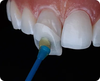 Phương pháp dán sứ veneer.