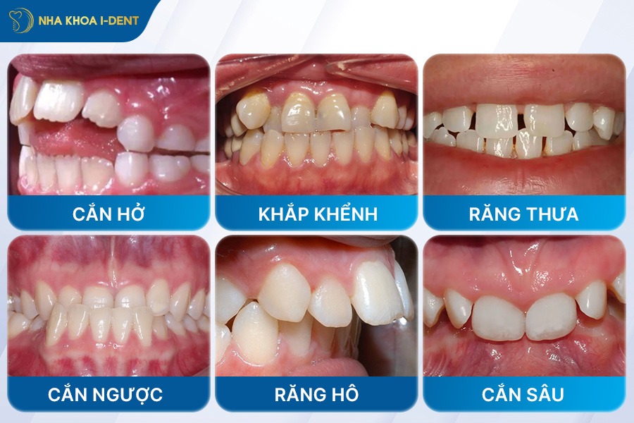 Tình trạng răng ban đầu ảnh hưởng đến chi phí niềng răng