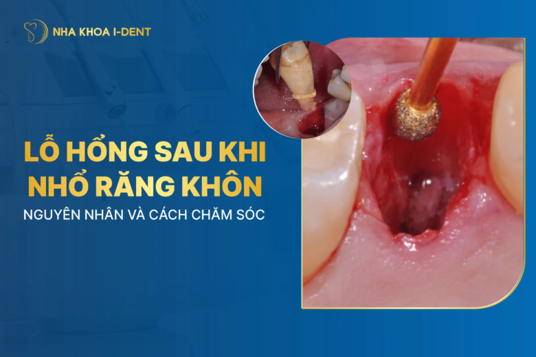 Lỗ hổng sau khi nhổ răng khôn