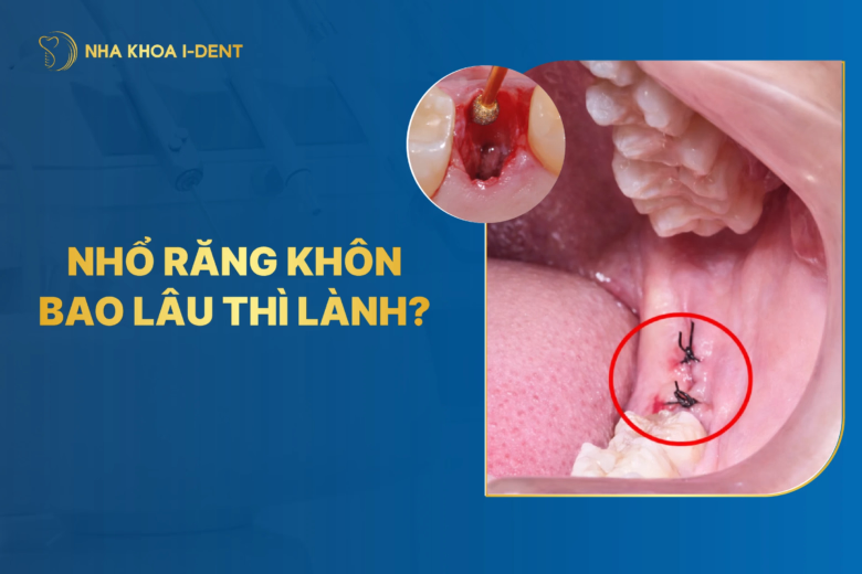 Nhổ răng khôn bao lâu thì lành