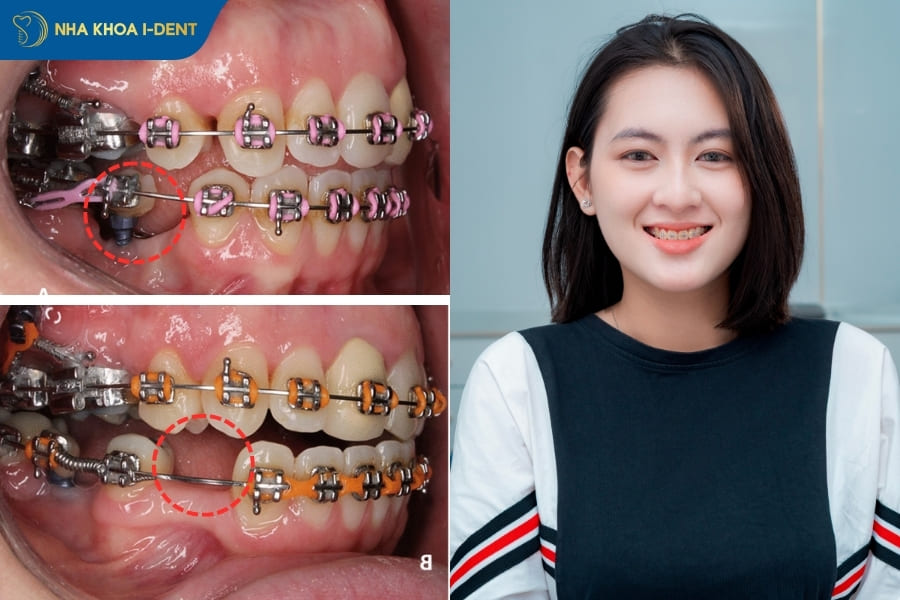 mất răng có niềng răng được không