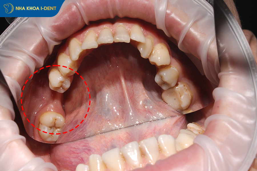bị tiêu xương hàm có chữa được không