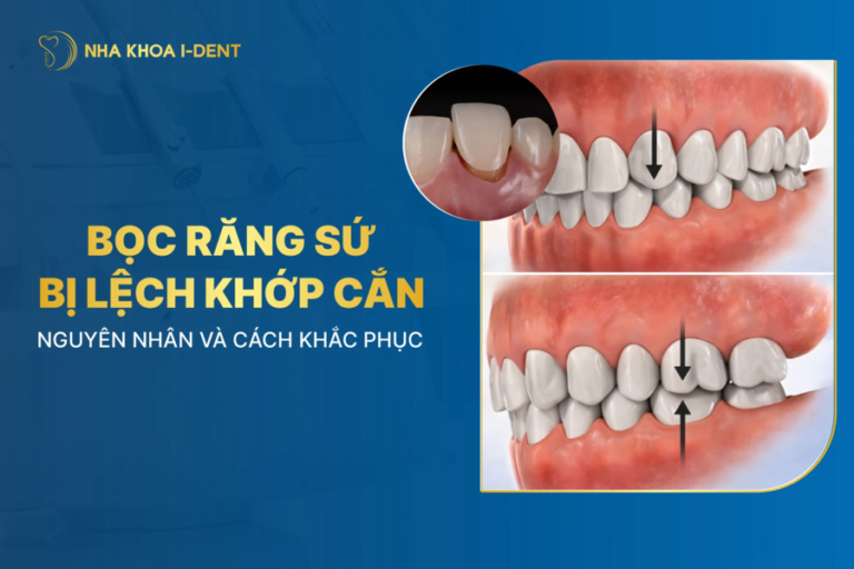 bọc răng sứ bị lệch khớp cắn
