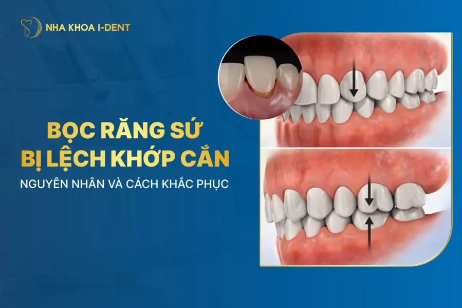 bọc răng sứ bị lệch khớp cắn
