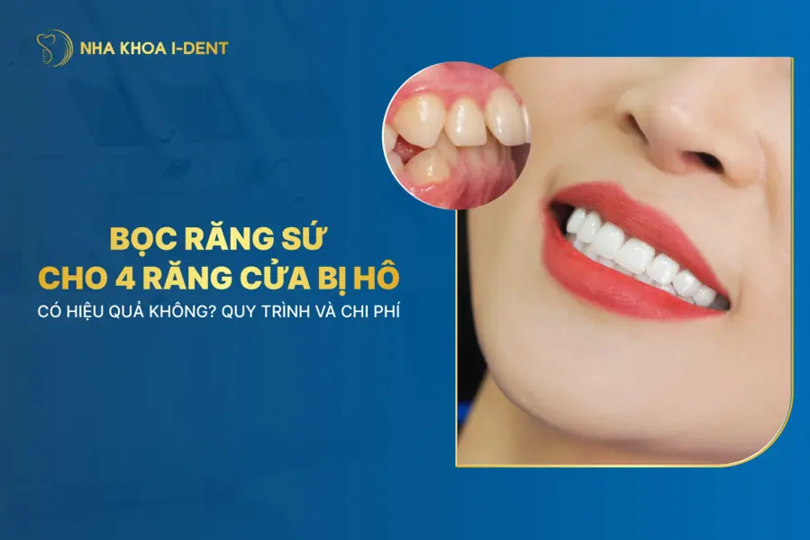 bọc răng sứ cho 4 răng cửa bị hô
