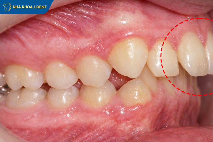 bọc răng sứ cho răng hô