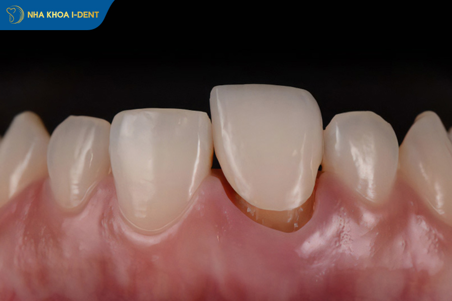 bọc sứ răng cửa bị lệch