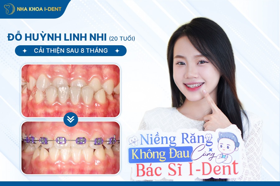các cách niềng răng phổ biến