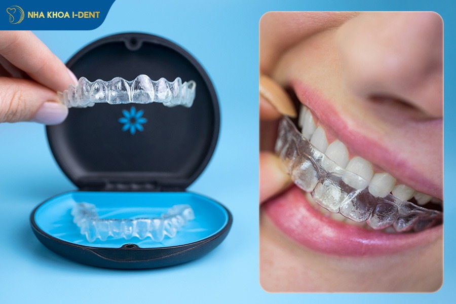 các cách niềng răng