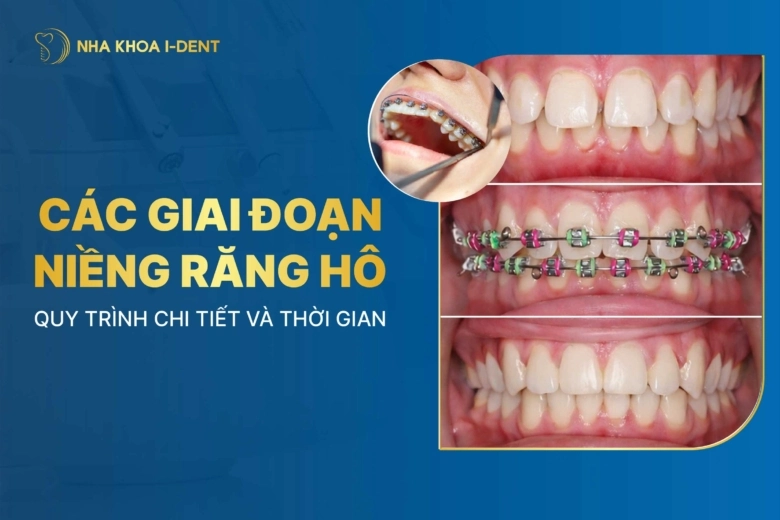 Các giai đoạn niềng răng hô: Quy trình, thời gian và sự thay đổi