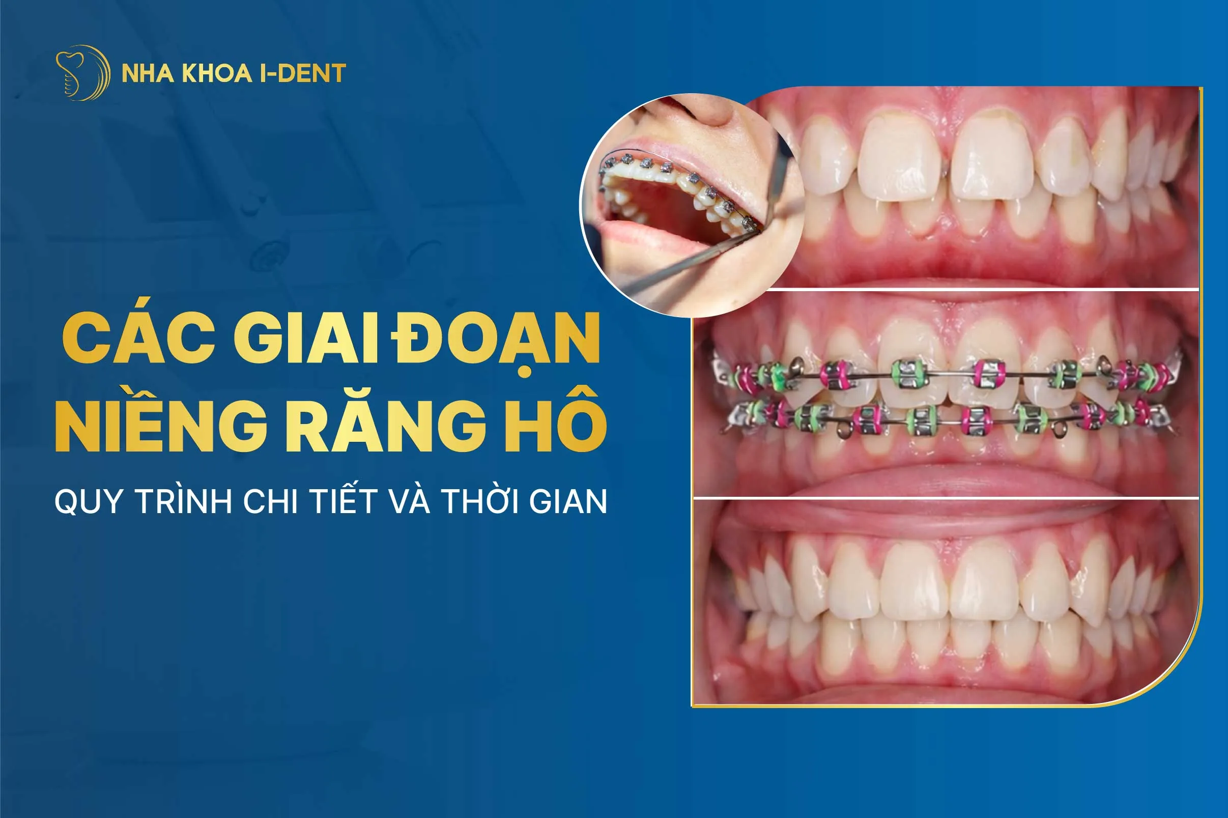 Các giai đoạn niềng răng hô: Quy trình, thời gian và sự thay đổi