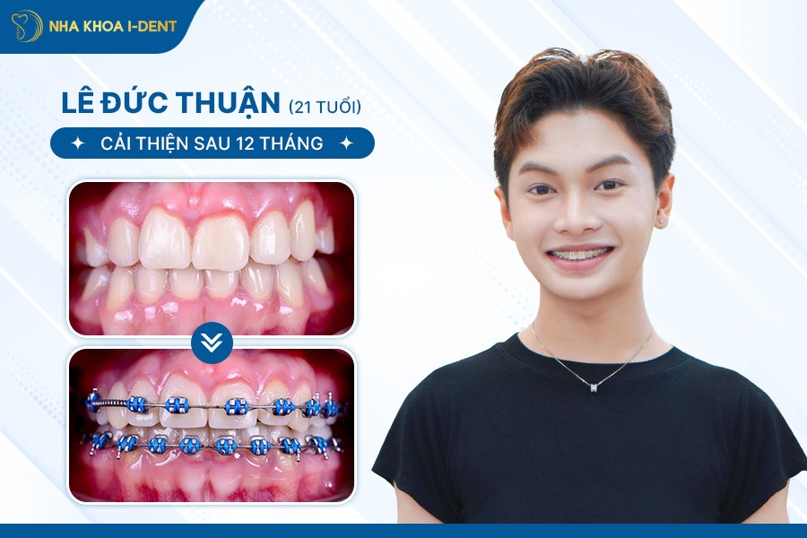 Kết quả trước và sau khi niềng răng bằng mắc cài kim loại