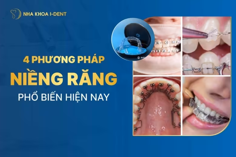 các phương pháp niềng răng phổ biến hiện nay