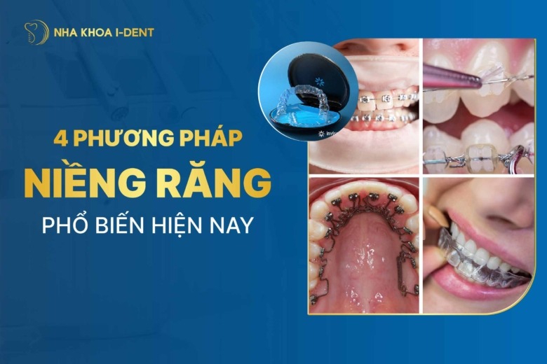 Các phương pháp niềng răng hiện nay: So sánh từng loại