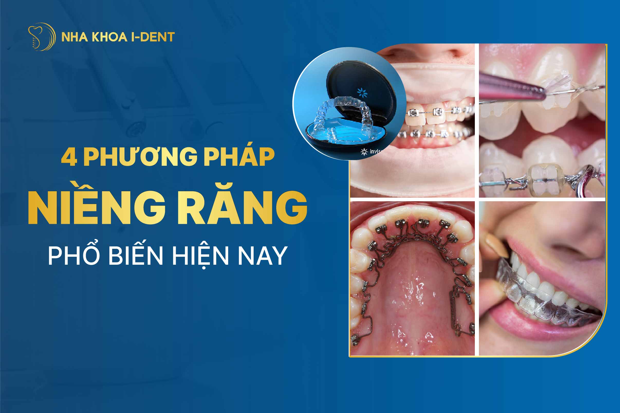 Các phương pháp niềng răng hiện nay: So sánh từng loại