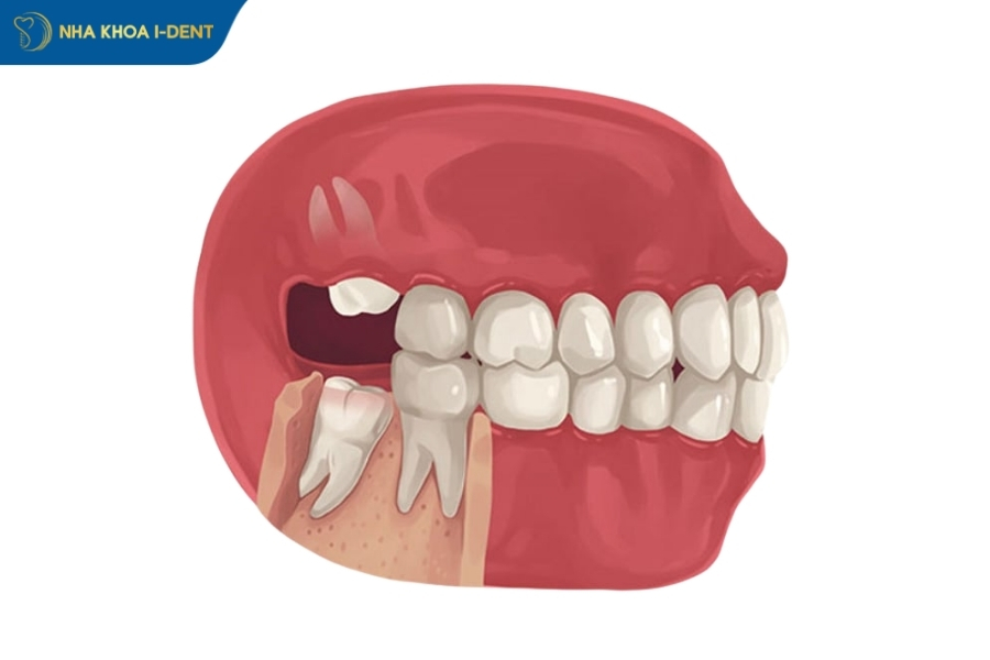 có nên nhổ răng số 8 hàm dưới không
