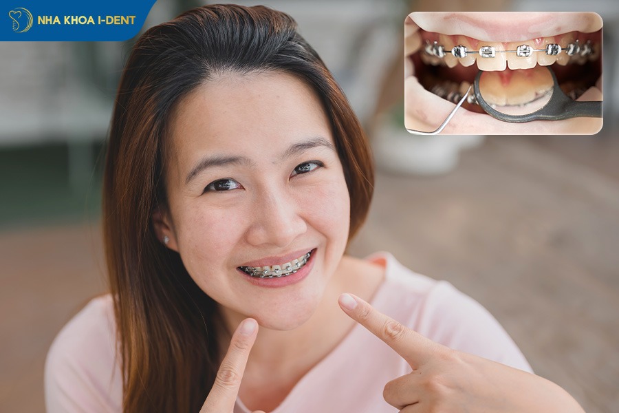 gắn mắc cài niềng răng hoàn toàn không đau