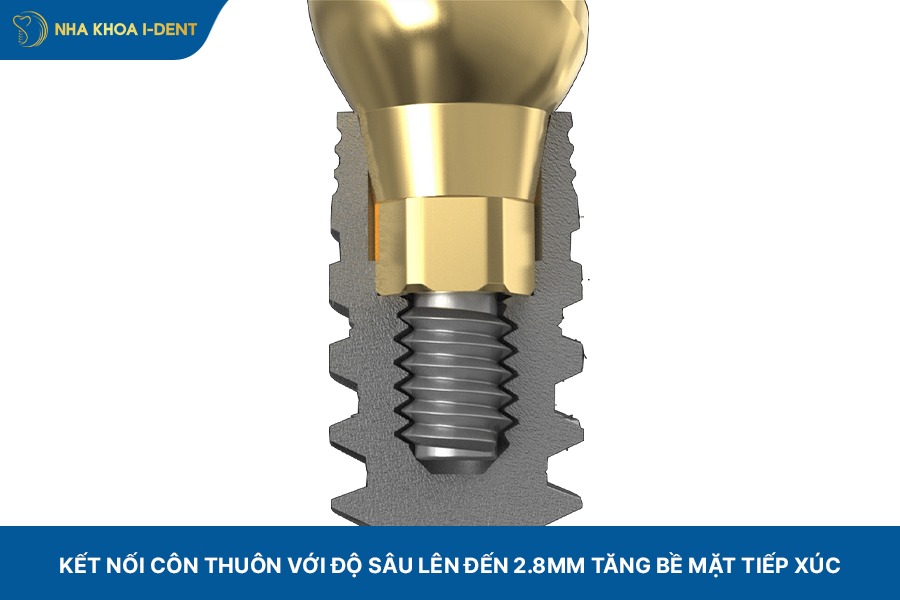 giá trụ implant etk pháp