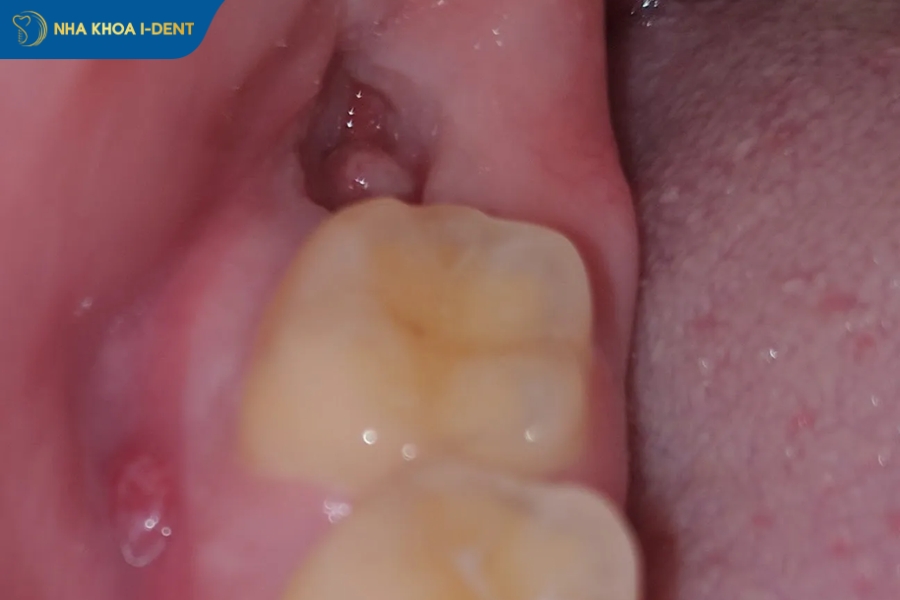 lỗ hổng sau khi nhổ răng