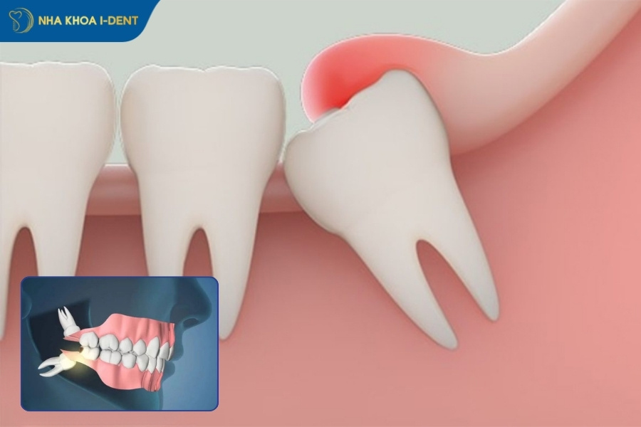 lưu ý khi nhổ răng khôn hàm dưới