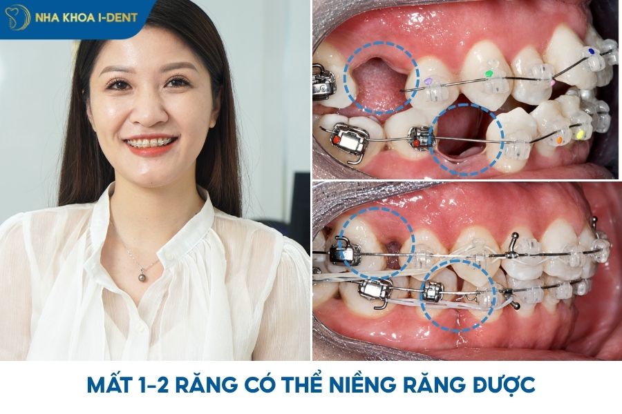 mất răng có niềng răng được không