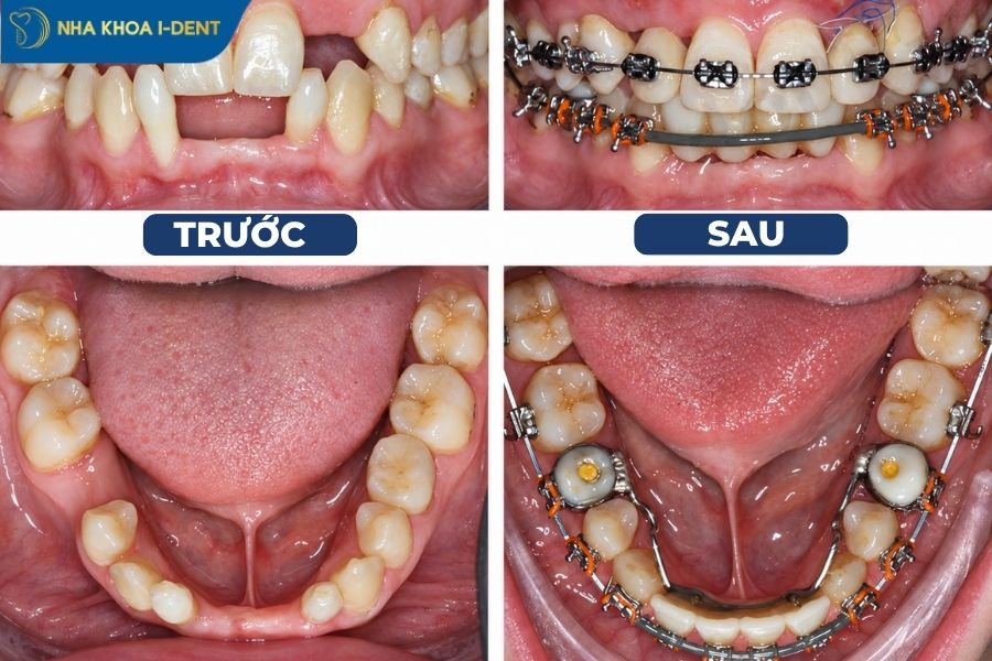 mất răng lâu năm có niềng được không