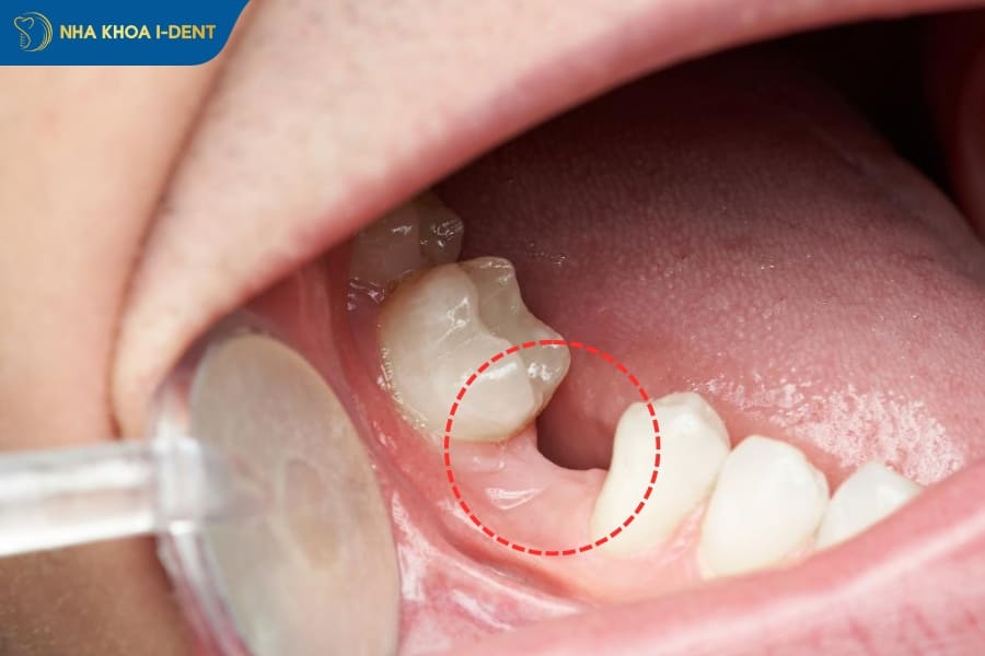 thiếu răng có niềng được không
