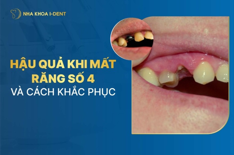 Mất răng số 4 nguy hiểm không? Hậu quả và cách khắc phục