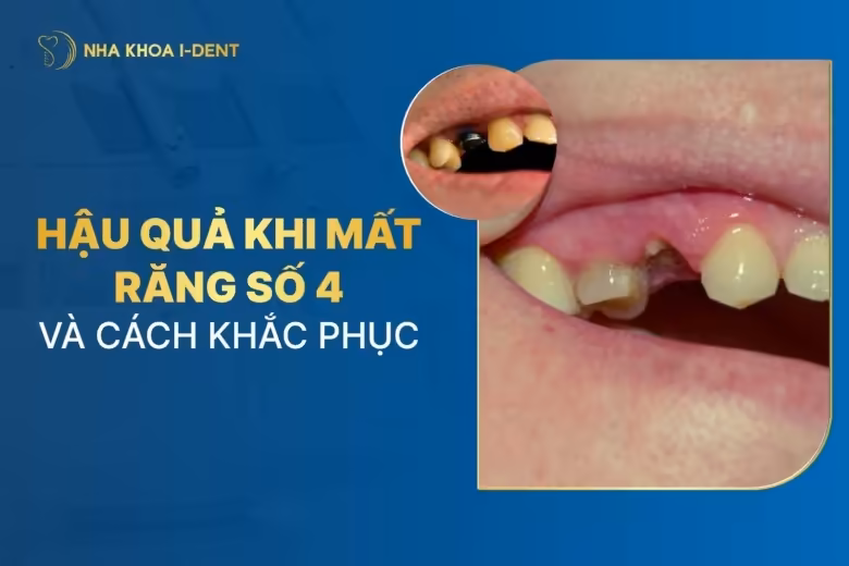 Mất răng số 4 nguy hiểm không? Hậu quả và cách khắc phục
