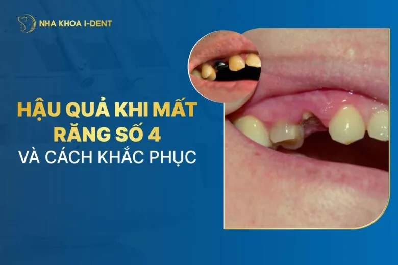 Mất răng số 4 nguy hiểm không? Hậu quả và cách khắc phục