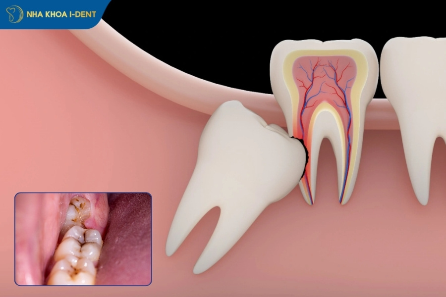 nhổ răng khôn bao lâu lành