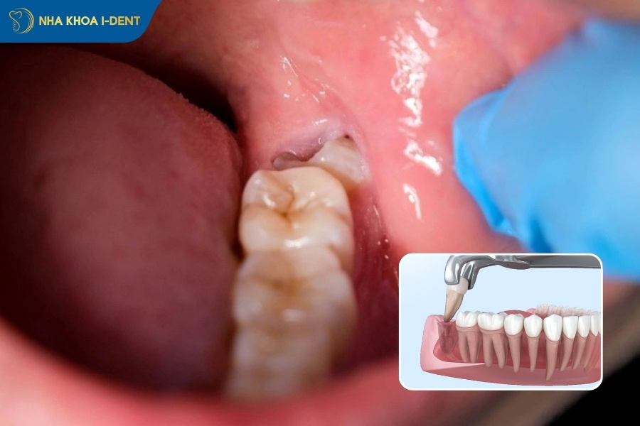 nhổ răng khôn có ảnh hưởng gì không