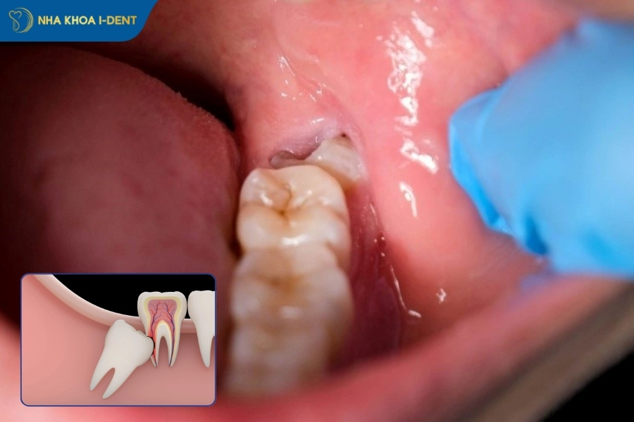 nhổ răng khôn không đau