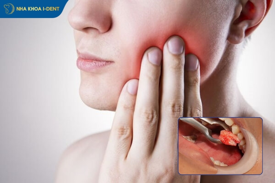 nhổ răng khôn mấy ngày hết đau